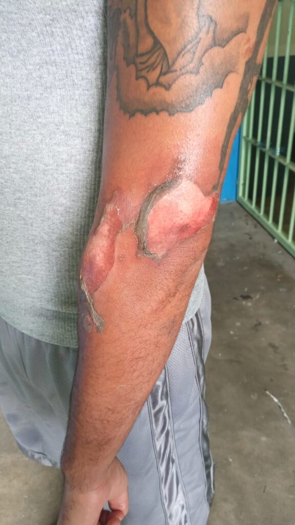 Shocking New Photos Videos Point Blanche St Maarten Prisoners 3rd Degree Burns DENIED MEDICAL ASSISTANCE